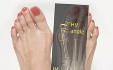 Carica l'immagine nel visualizzatore di Gallery, Say Goobye to Hallux Valgus Now